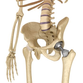 toxicity of metal hip implants